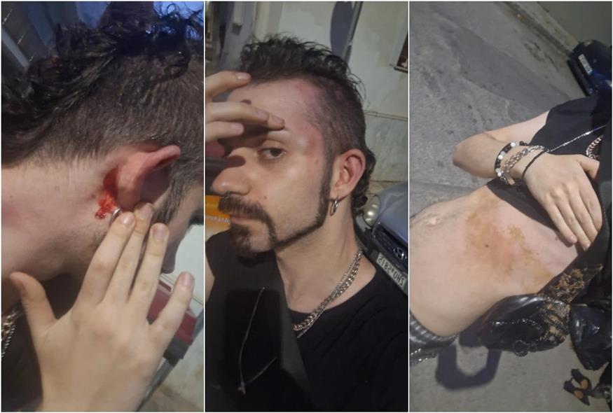 Ομοφοβική επίθεση σε 24χρονο στην Ανθούπολη