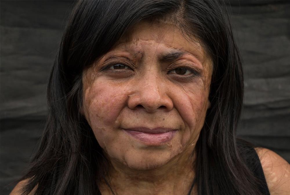 «Μπορούσα να αφήσω τον εαυτό μου να πεθάνει ή να κατανοήσω τη νέα μου πραγματικότητα» - Οι γυναίκες – θύματα επιθέσεων με οξύ συσπειρώνονται και αναζητούν δικαιοσύνη