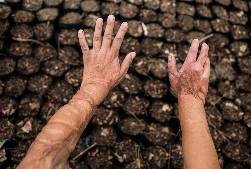 «Μπορούσα να αφήσω τον εαυτό μου να πεθάνει ή να κατανοήσω τη νέα μου πραγματικότητα» - Οι γυναίκες – θύματα επιθέσεων με οξύ συσπειρώνονται και αναζητούν δικαιοσύνη