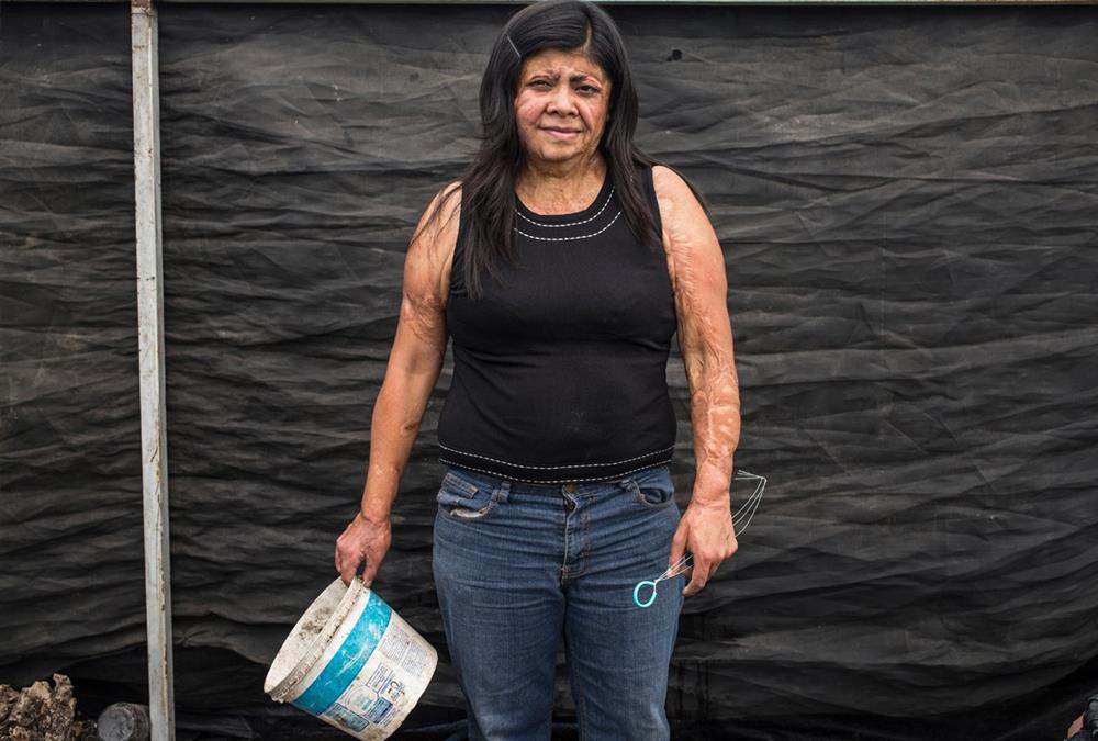 «Μπορούσα να αφήσω τον εαυτό μου να πεθάνει ή να κατανοήσω τη νέα μου πραγματικότητα» - Οι γυναίκες – θύματα επιθέσεων με οξύ συσπειρώνονται και αναζητούν δικαιοσύνη