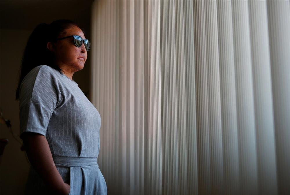 «Μπορούσα να αφήσω τον εαυτό μου να πεθάνει ή να κατανοήσω τη νέα μου πραγματικότητα» - Οι γυναίκες – θύματα επιθέσεων με οξύ συσπειρώνονται και αναζητούν δικαιοσύνη