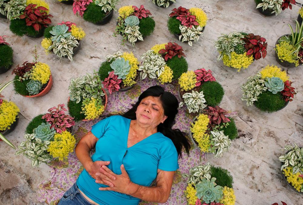 «Μπορούσα να αφήσω τον εαυτό μου να πεθάνει ή να κατανοήσω τη νέα μου πραγματικότητα» - Οι γυναίκες – θύματα επιθέσεων με οξύ συσπειρώνονται και αναζητούν δικαιοσύνη