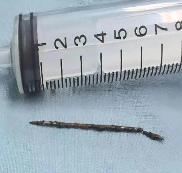 Η βελόνα που αφαιρέθηκε (Yingxin Ren et al./New York Post) Η βελόνα που αφαιρέθηκε (Yingxin Ren et al./New York Post)