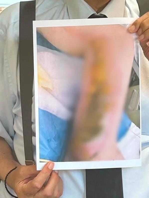 Έγκαυμα σε 20χρονη Έγκαυμα σε 20χρονη