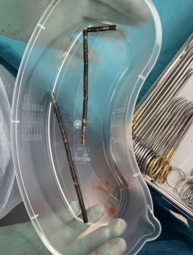 Μαγνήτες στο έντερο ανήλικου