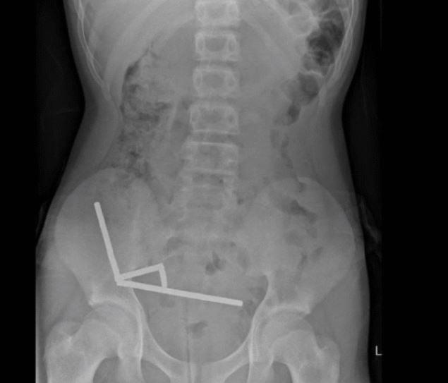 Μαγνήτες στο έντερο ανήλικου