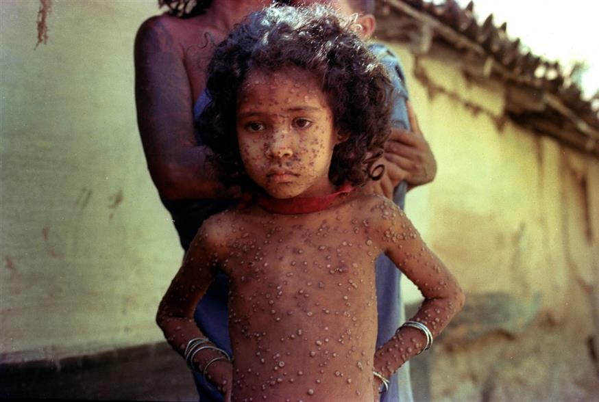Παιδί στην Ινδία με ευλογιά στην 10ετία του 1970. /copyright Ap Photos