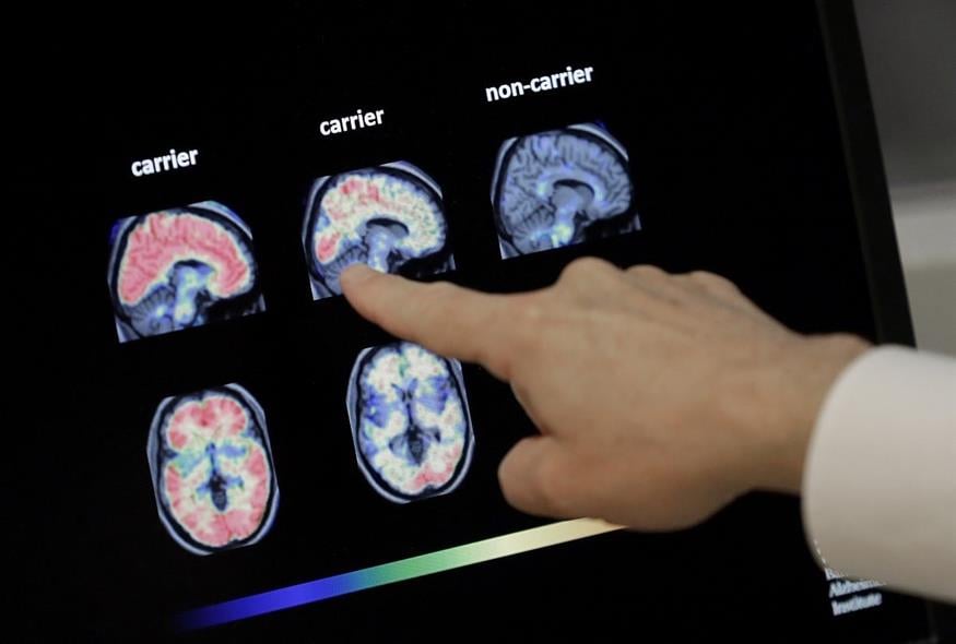 Μαγνητική εγκεφάλου ασθενών με Αλτσχάιμερ (φωτογραφία αρχείου/ Associated Press)