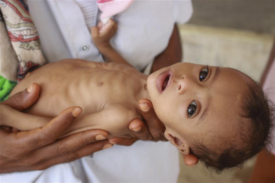 Υποσιτισμένο βρέφος στην Υεμένη/Copyright: AP Images