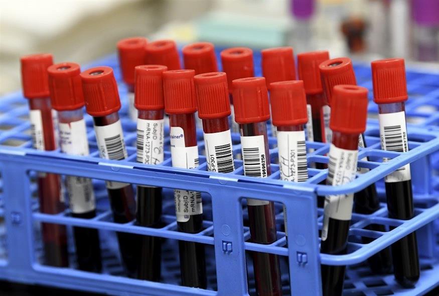 Νέο τεστ αίματος προβλέπει τον κίνδυνο εμφράγματος και εγκεφαλικού με αυξημένη ακρίβεια (φωτογραφία αρχείου / Associated Press)