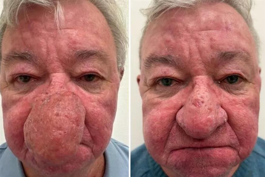 Σπάνια πάθηση στη μύτη