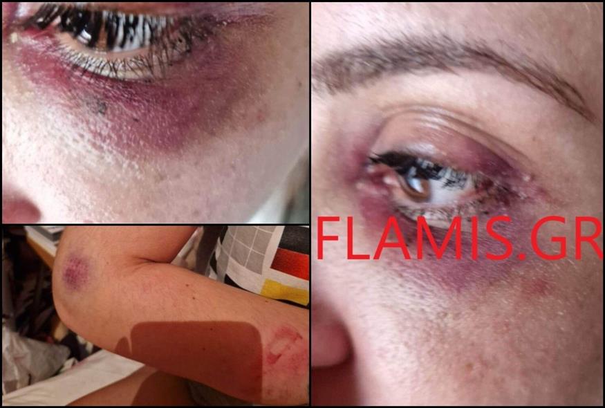 Συγκλονίζει 31χρονη που καταγγέλλει ξυλοδαρμό από τον σύντροφό της (Φωτογραφίες: flamis.gr)