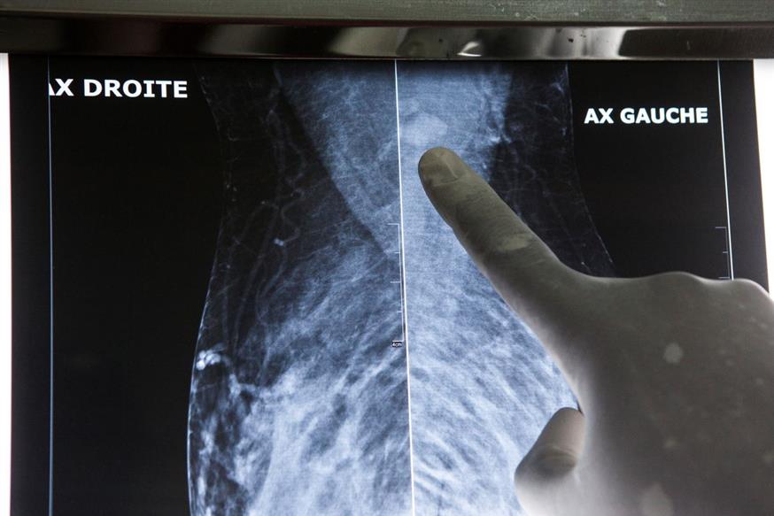 Ακτινογραφία ασθενή με καρκίνο/Associated Press