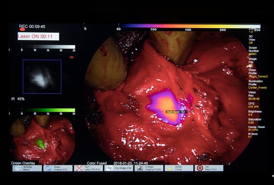 Μια οθόνη δείχνει έναν όγκο σε έναν ασθενή, ο οποίος γίνεται ορατός με τη χρήση ειδικής κάμερας και φθορίζουσας χρωστικής στο Νοσοκομείο του Πανεπιστημίου της Πενσυλβάνια στη Φιλαδέλφεια / AP Photo/Matt Rourke