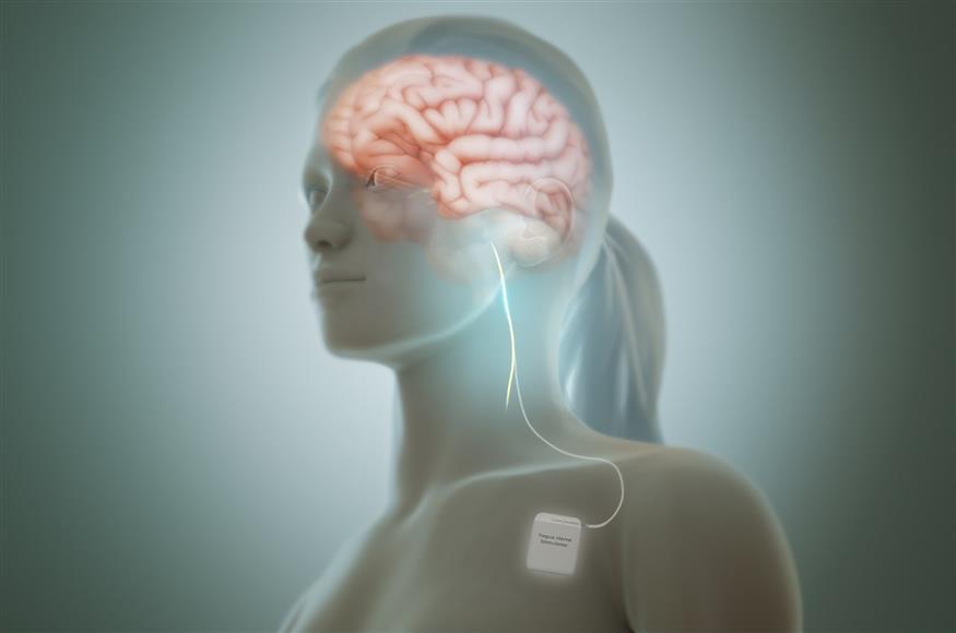 Διέγερση του πνευμονογαστρικού νεύρου με μέθοδο VNS