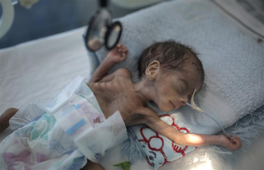 Υποσιτισμένο νεογέννητο στην Υεμένη/AP Images