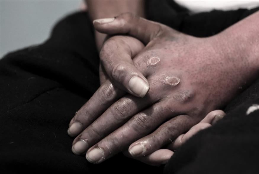 Χέρια με εγκαύματα  (Φωτογραφία αρχείου/AP Photo/Fernando Vergara)