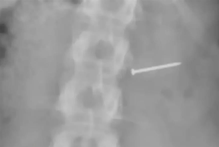 Η ακτινογραφία με το καρφί (New York Post)