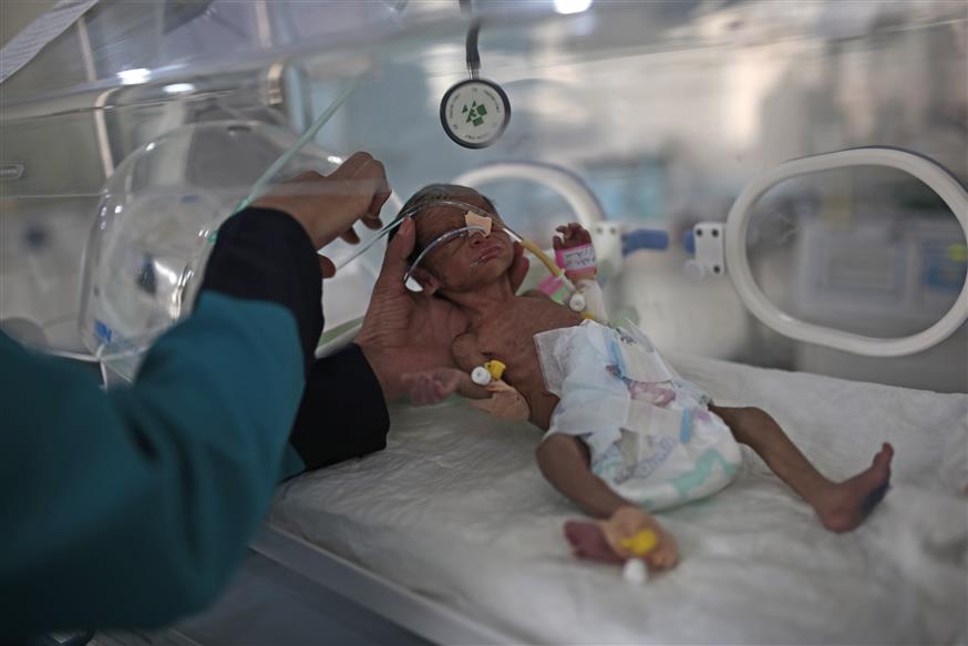 Υποσιτισμένο βρέφος στην Υεμένη/Copyright: AP Images