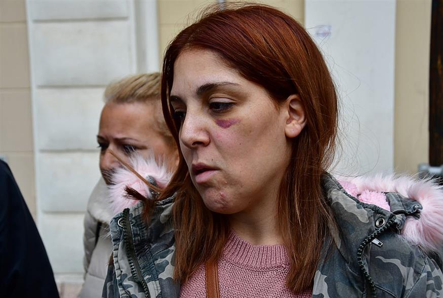 Η 32χρονη που κακοποιείτο από τον σύζυγό της στο Άργος (ΙΝΤΙΜΕ/ΜΠΟΥΓΙΩΤΗΣ ΒΑΓΓΕΛΗΣ)