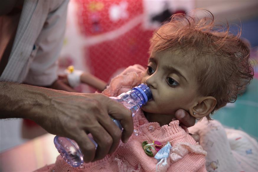 Malnourished child/(AP Photo/Hani Mohammed, File)