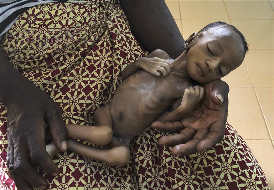 Υποσιτισμένο βρέφος εν μέσω κορονοϊού στη Μπουρκίνα Φάσο/AP Images