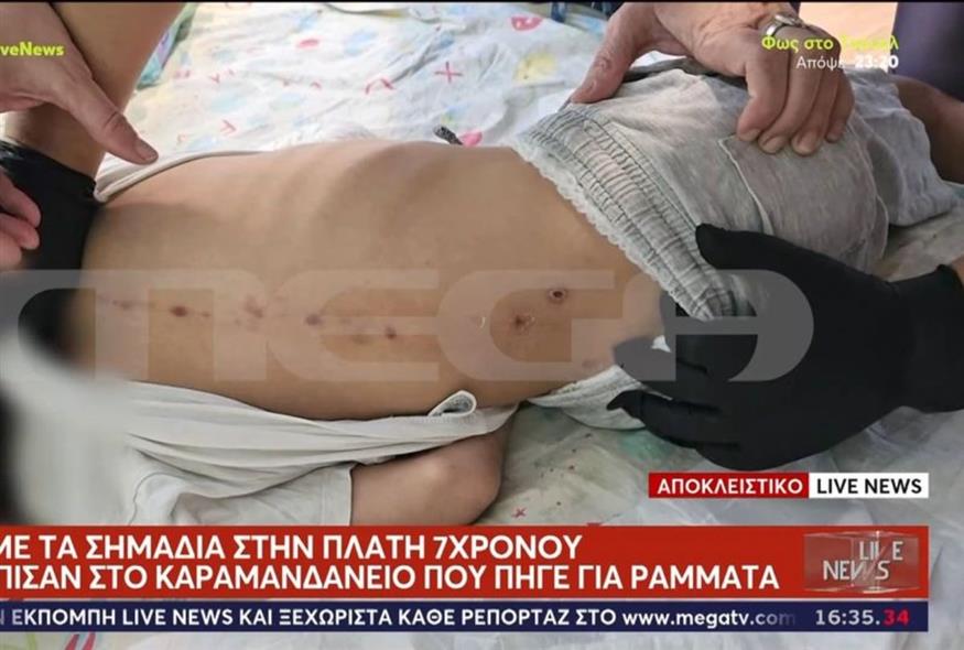 Καραμανδάνειο: Τα σημάδια στην πλάτη του 7χρονου που κινητοποίησαν τους γιατρούς (GLOMEX)