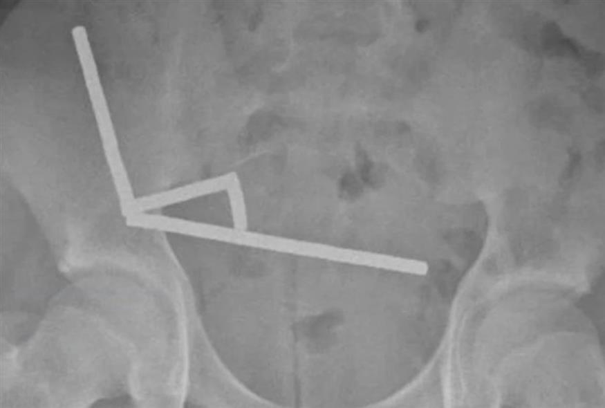 Μαγνήτες στο έντερο ανήλικου (New Zealand Medical Journal)