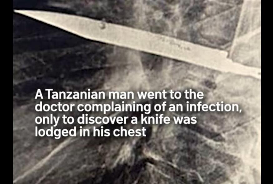 Γιατροί στην Τανζανία ανακάλυψαν μαχαίρι στο στήθος 44χρονου (NBC Chicago)