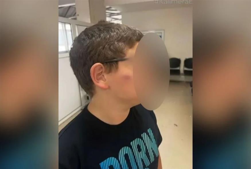 Στιγμιότυπο με τον άτυχο 11χρονο μετά την επίθεση (ANT1/Glomex)